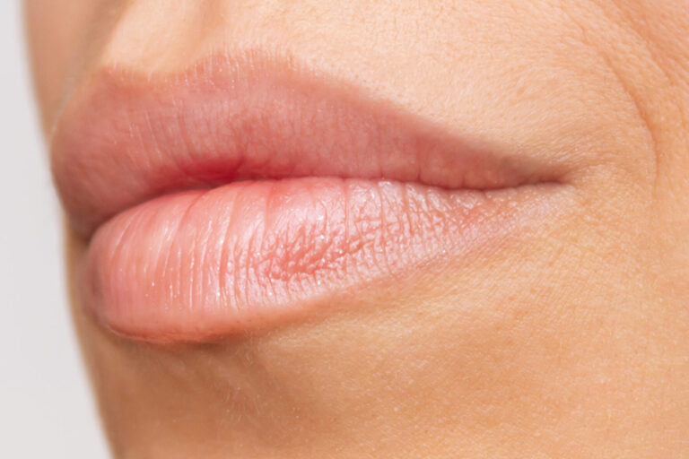 Filler labbra tecnica Russian Lips