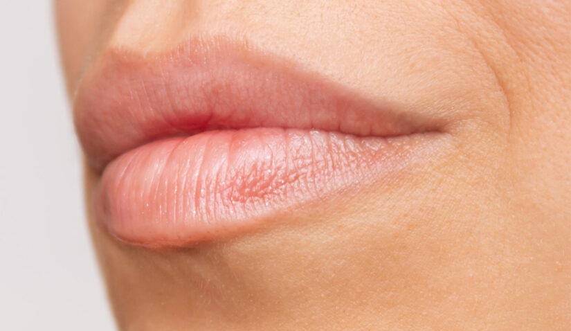 Filler labbra tecnica Russian Lips