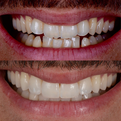 alcuni esempi di faccette dentali a Cattolica