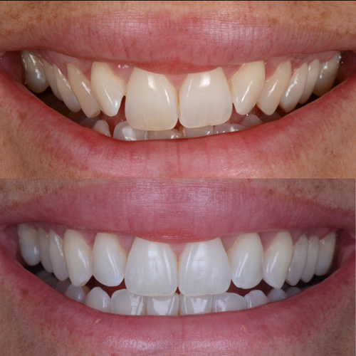 alcuni esempi di faccette dentali a Cattolica
