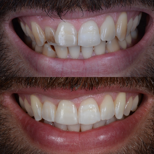 alcuni esempi di faccette dentali a Cattolica