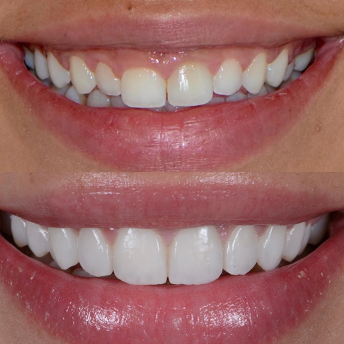 applicazione delle faccette dentali