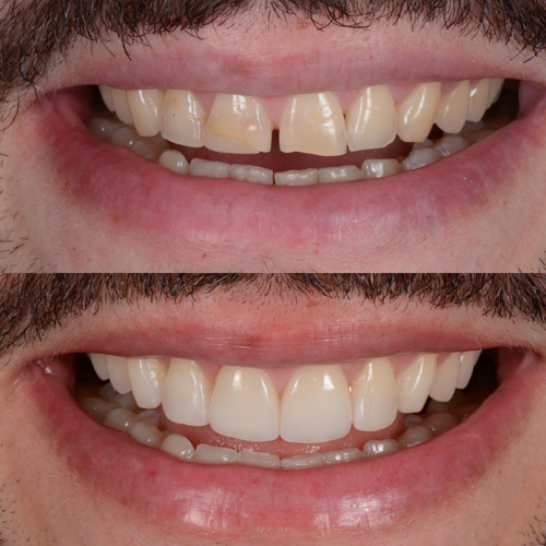 applicazione delle faccette dentali