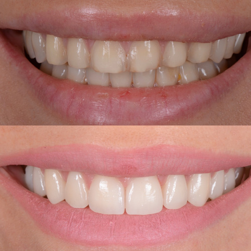 Faccette dentali in ceramica a Cattolica