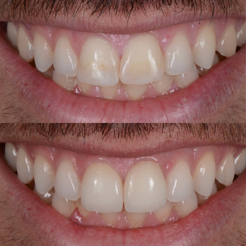 Faccette dentali in ceramica a Cattolica