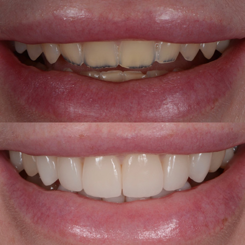 applicazione delle faccette dentali