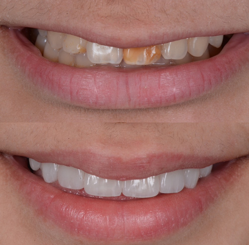 applicazione delle faccette dentali