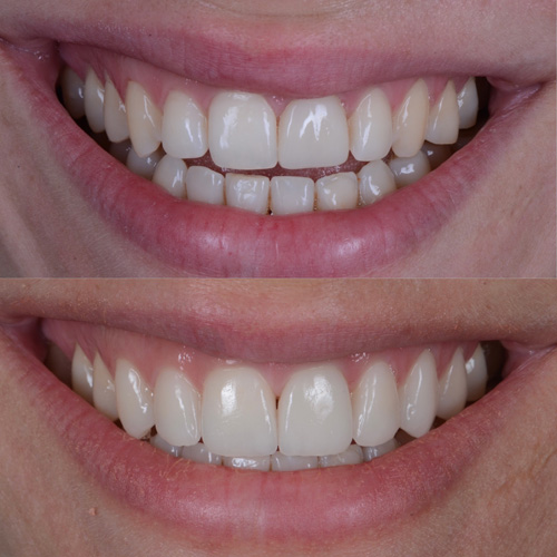 Faccette dentali in ceramica a Cattolica