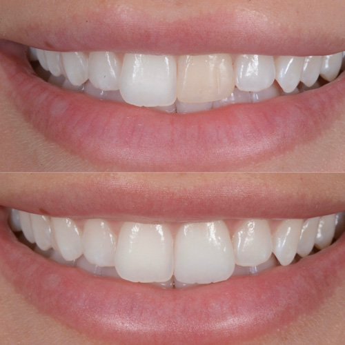 Faccette dentali in ceramica a Cattolica