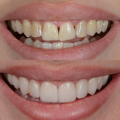 Faccette dentali in ceramica a Cattolica