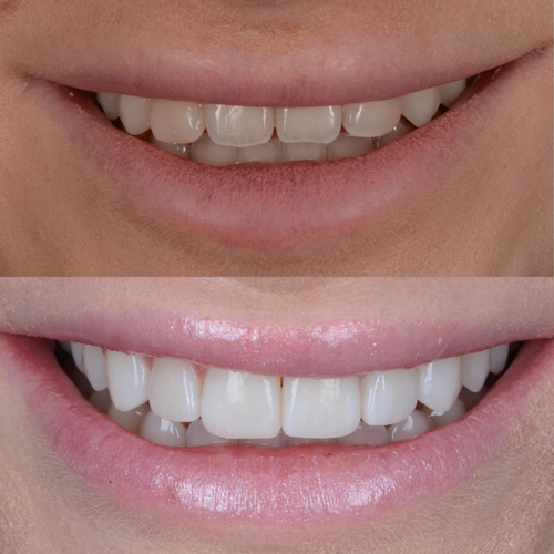 alcuni esempi di faccette dentali a Cattolica