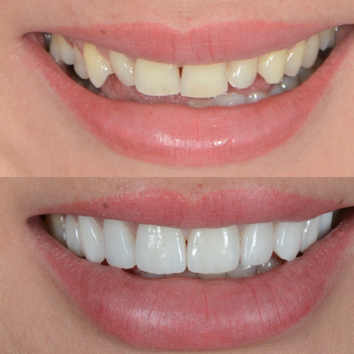 applicazione delle faccette dentali