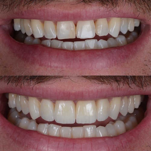 applicazione delle faccette dentali
