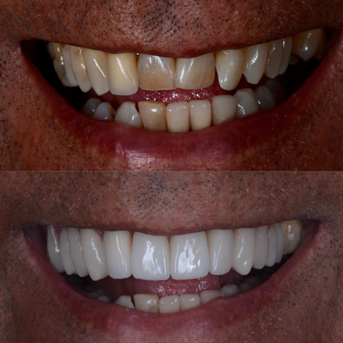 applicazione delle faccette dentali
