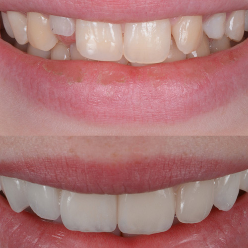 applicazione delle faccette dentali