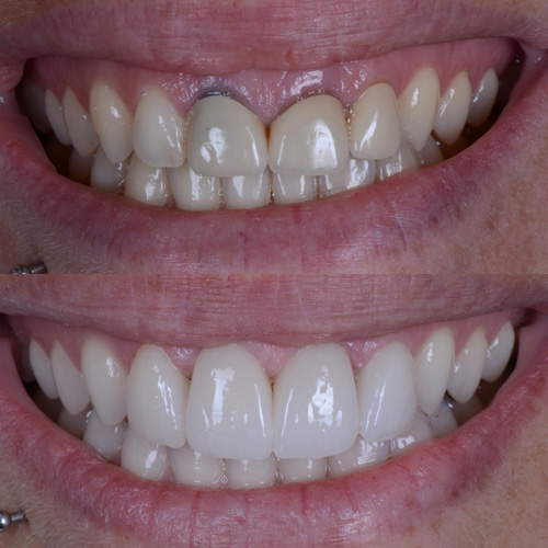 applicazione delle faccette dentali
