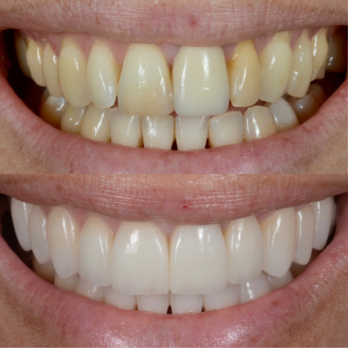 applicazione delle faccette dentali
