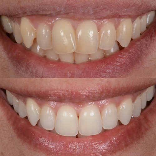 alcuni esempi di faccette dentali a Cattolica