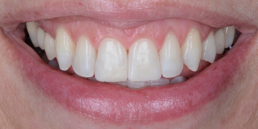 alcuni esempi di faccette dentali a Cattolica