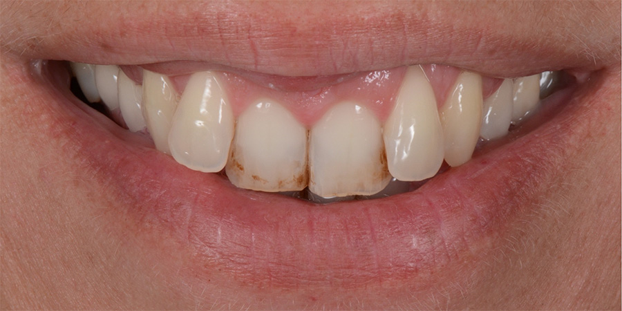 alcuni esempi di faccette dentali a Cattolica