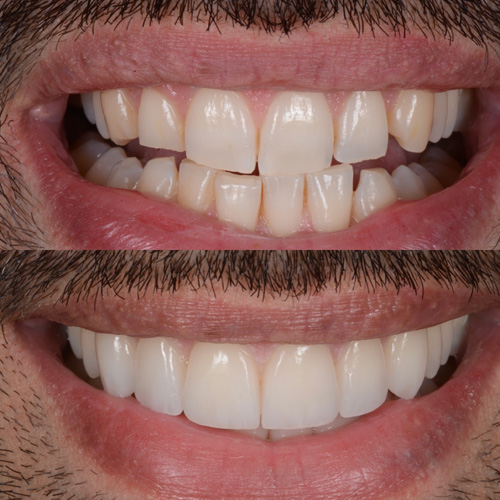applicazione delle faccette dentali