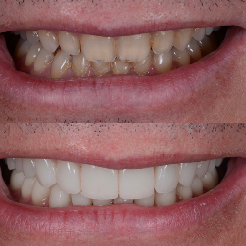 applicazione delle faccette dentali
