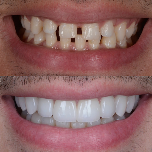 applicazione delle faccette dentali