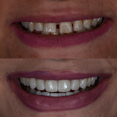 applicazione delle faccette dentali