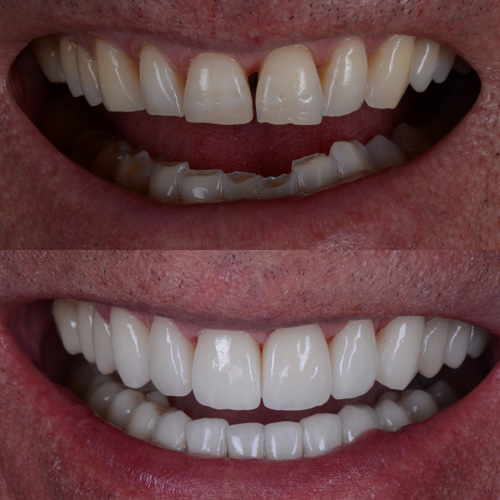 applicazione delle faccette dentali