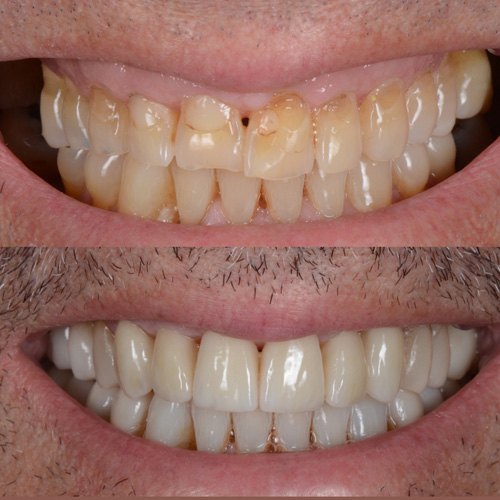 applicazione delle faccette dentali