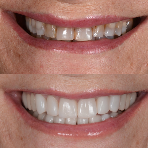 applicazione delle faccette dentali