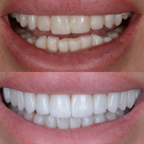 applicazione delle faccette dentali