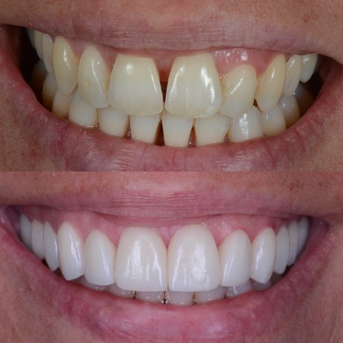 applicazione delle faccette dentali