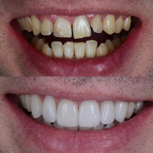 Faccette dentali in ceramica a Cattolica