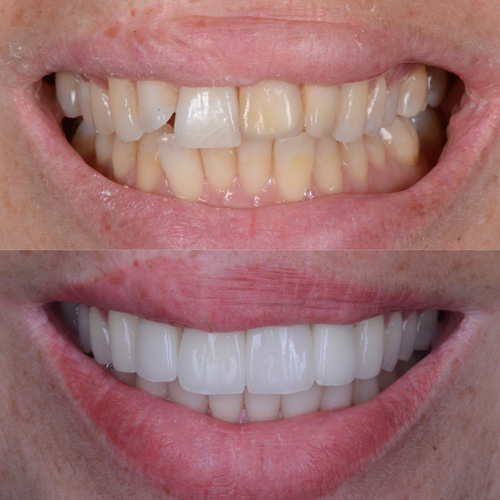 alcuni esempi di faccette dentali a Cattolica