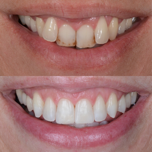 alcuni esempi di faccette dentali a Cattolica
