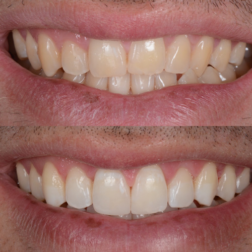 alcuni esempi di faccette dentali a Cattolica
