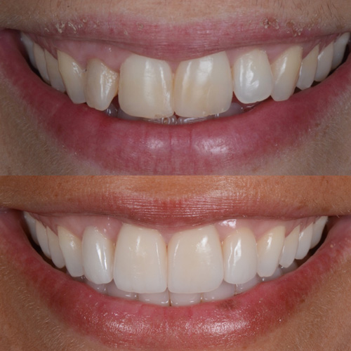 alcuni esempi di faccette dentali a Cattolica