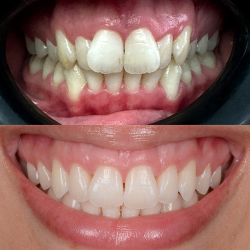 alcuni esempi di faccette dentali a Cattolica