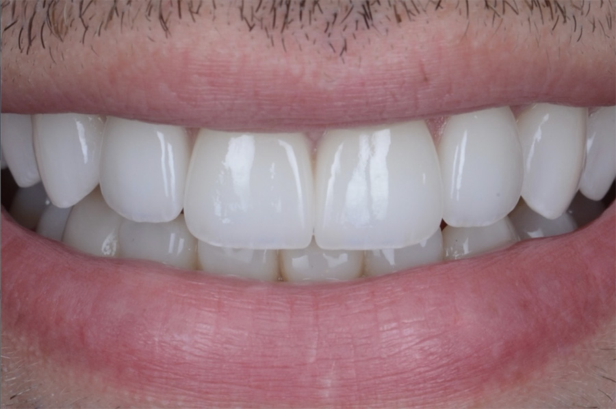 risultato con faccette dentali
