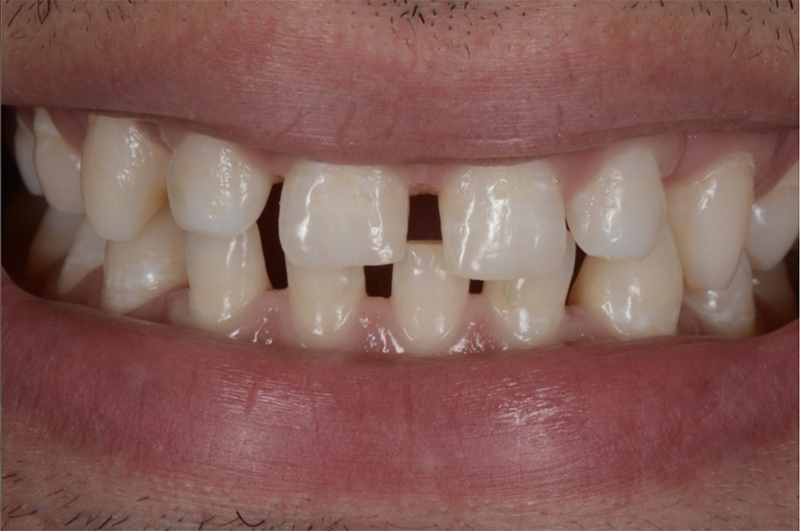 Situazione prima delle faccette dentali