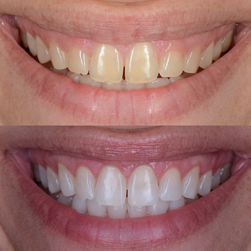 Sorriso perfetto | dentista ferrarini di cattolica