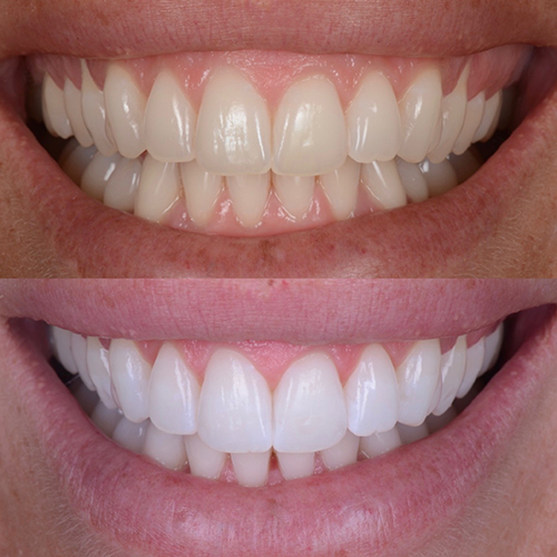 Sorriso perfetto | dentista ferrarini di cattolica