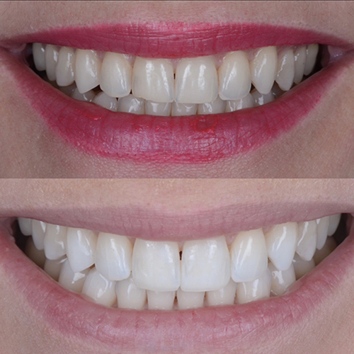 Sorriso perfetto | dentista ferrarini di cattolica