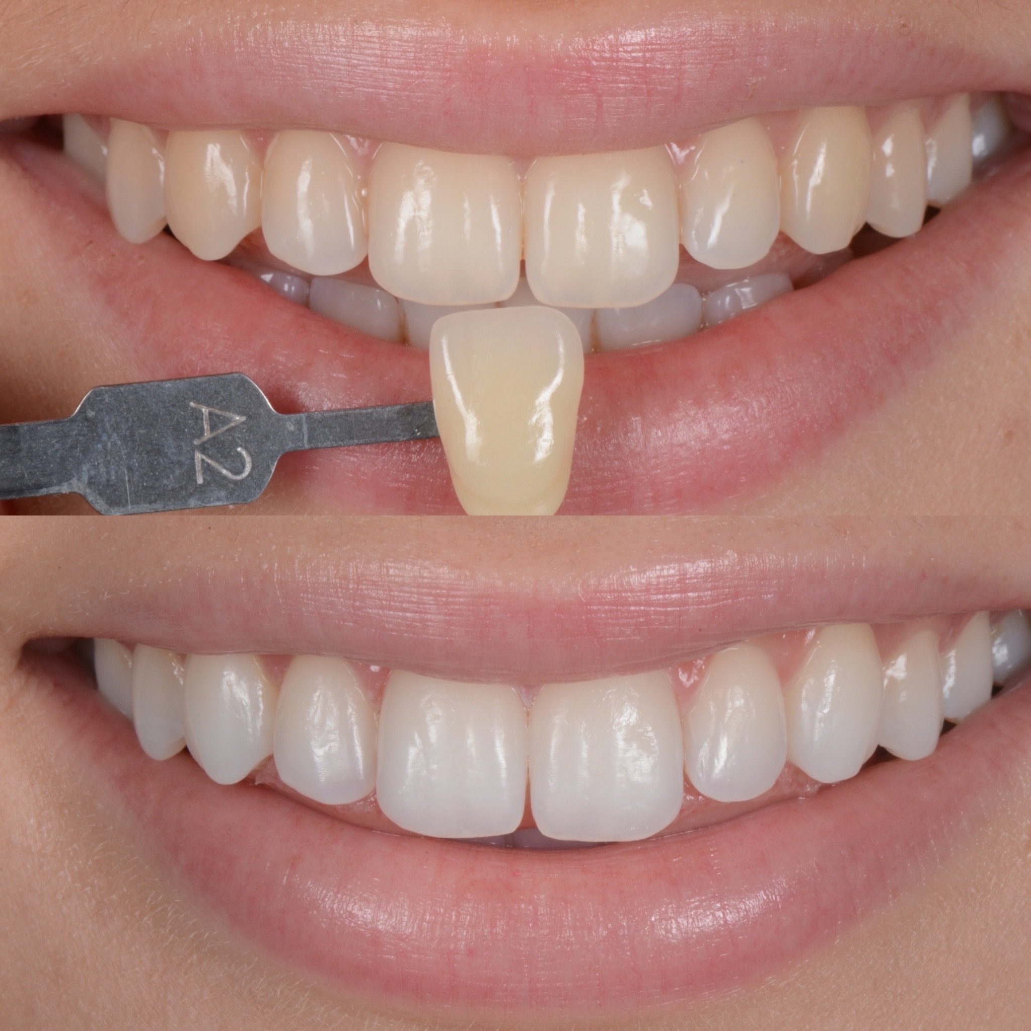 Trattamento di sbiancamento dentale
